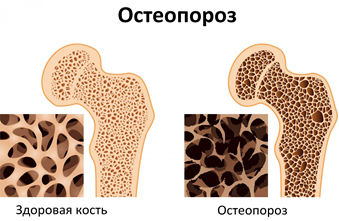 Остеопопроз под микроскопом